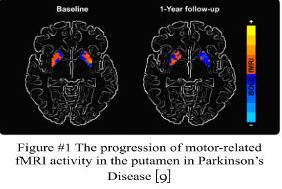 An Investigation on Parkinson’s Disease and Music Therapy